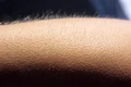Pielea de găină apare în caz de frig sau emoție jpeg