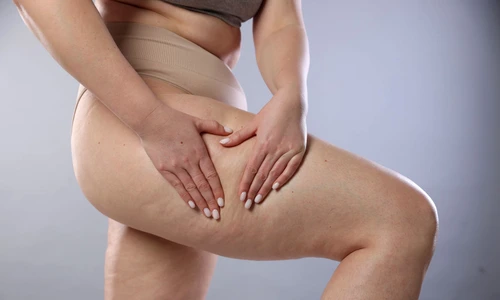 celulita shutterstock 2592278055 jpg