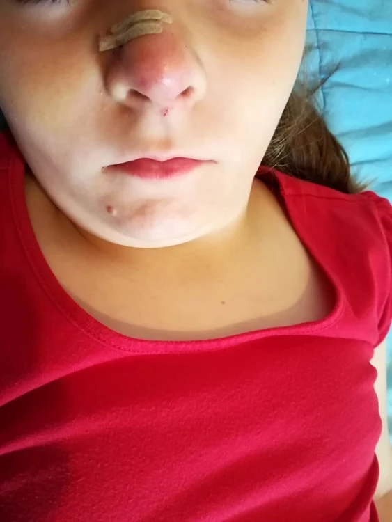 Emanuela Lupu a fost mușcată de nas