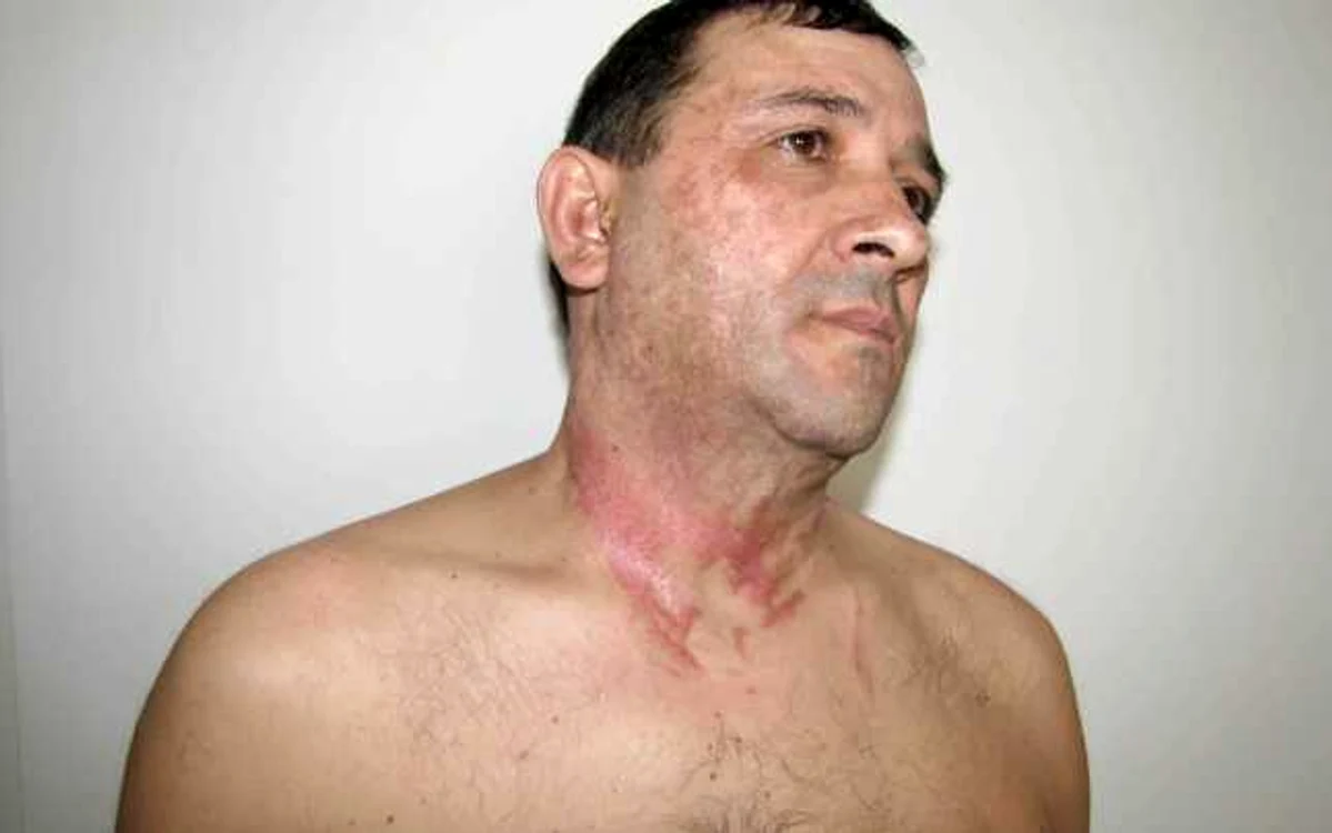 Ionel Pavel, angajat al Pakmaya, a fost ars cu acid sulfuric FOTO Ionuţ Benea