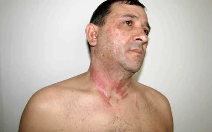 Ionel Pavel, angajat al Pakmaya, a fost ars cu acid sulfuric FOTO Ionuţ Benea