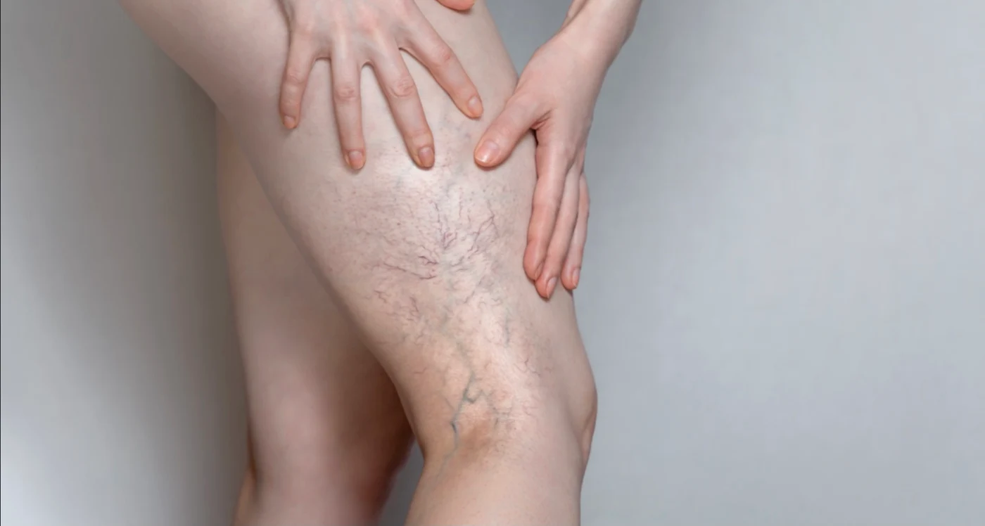 
    Varicele nu sunt doar inestetice, ci pot duce la complicații severeFoto: Shutterstock  