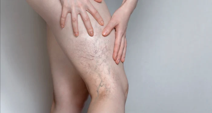 
    Varicele nu sunt doar inestetice, ci pot duce la complicații severeFoto: Shutterstock  