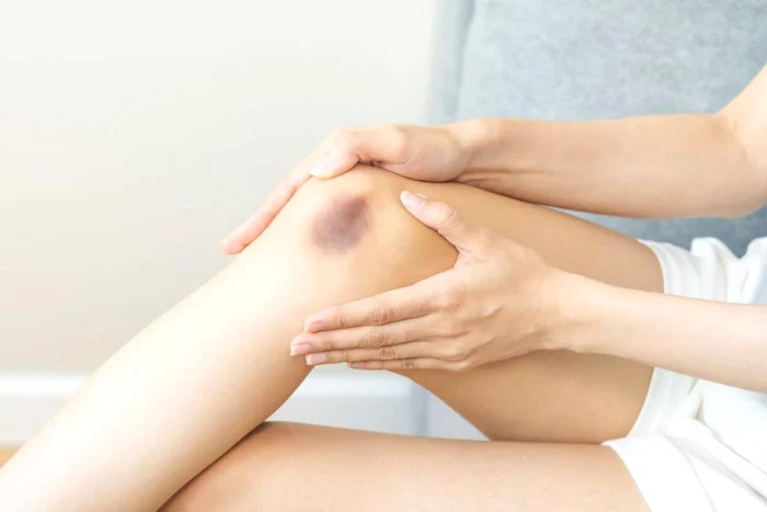 Cremă cu arnică și afine, făcută în casă, care te ajută să scapi rapid de vânătăi.