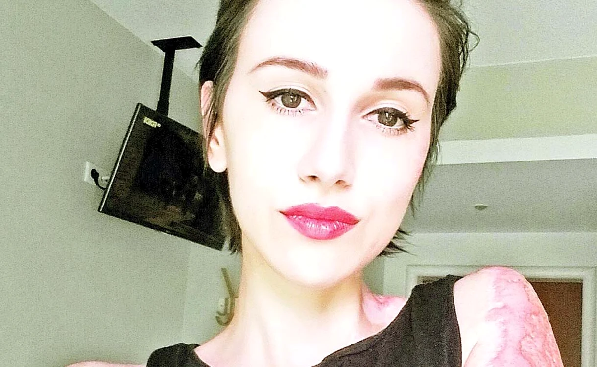 
    Alexandra a rămas  cu cicatrici foarte  dureroase pe corp  