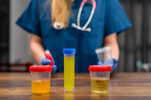 Culoarea urinei arată că rinichii tăi pot fi în pericol