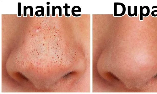 Mască pentru puncte negre  Cum îţi faci benzi pentru nas, acasă jpeg