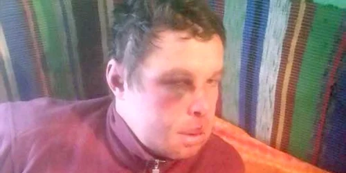 pacient batut socola sursa ziarul de iasi
