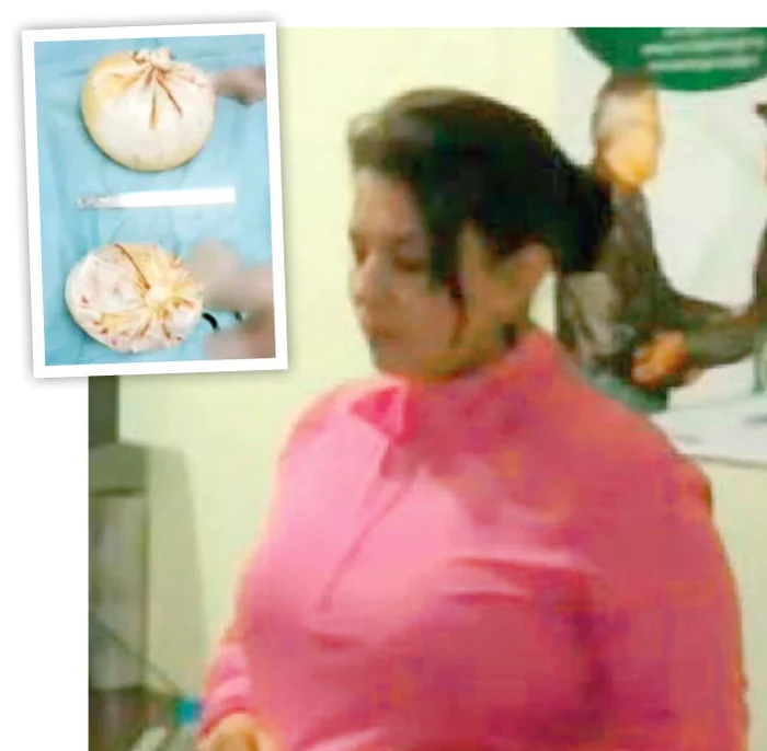 Înainte de a fi dusă la puşcărie, medicii i-au scos drogurile din piept