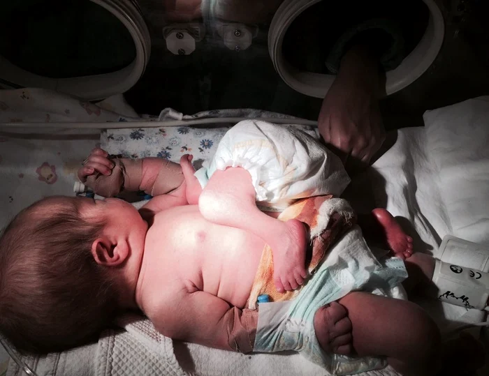 Cei doi băieței sunt uniți în zona abdominală, unul dintre ei nefiind dezvoltat corespunzător (Foto: click.ro)