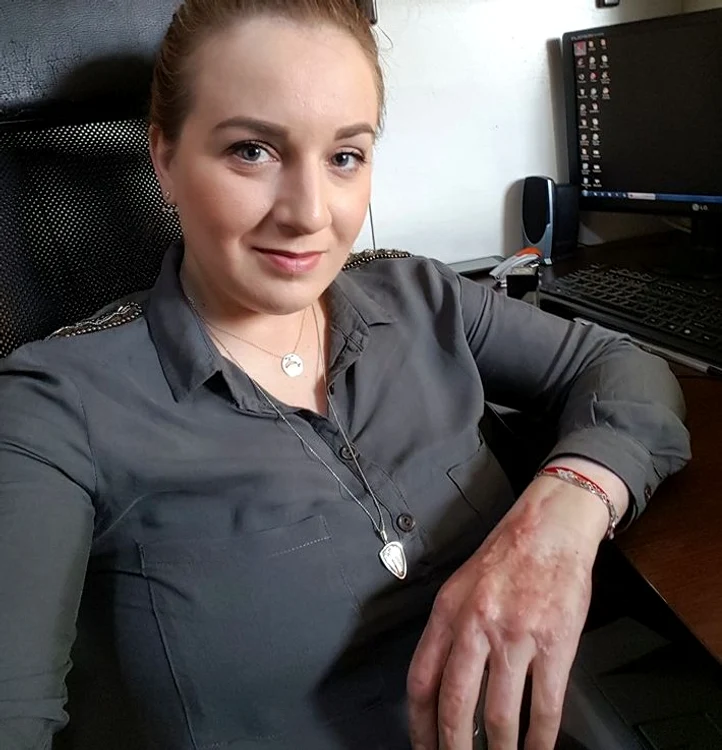 
    Corina a suferit arsuri grave ale brațelorfoto: arhiva personală  