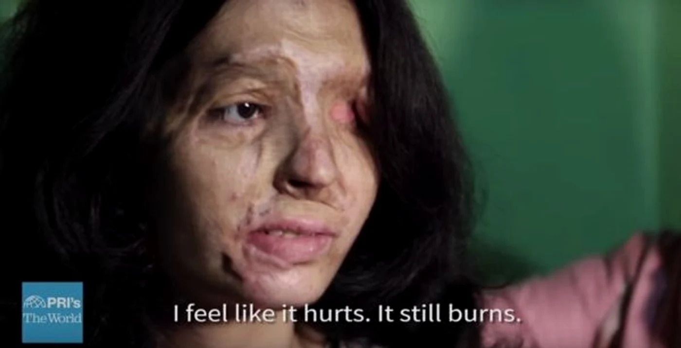 Reshma Quereshi a fost atacată cu acid sulfuricFoto: upworthy.com