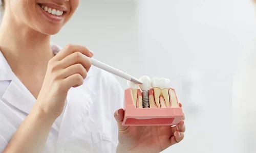 implant jpg