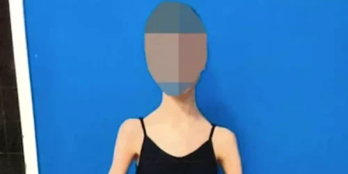 ballerina malnourished perth 013125 4 08305e08a850435d9edb0bc0df6b5598 webp