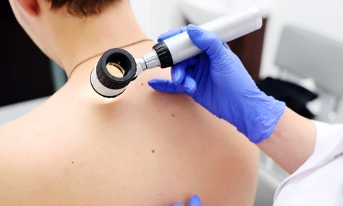 1 dermatoscop jpg jpeg