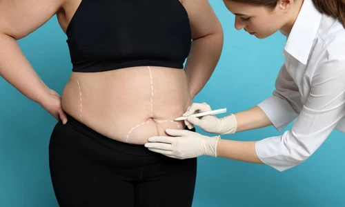 operatie bariatrica jpg