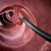 1 polipi colon jpg jpeg