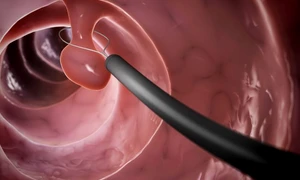 1 polipi colon jpg jpeg