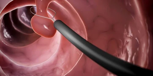 1 polipi colon jpg jpeg