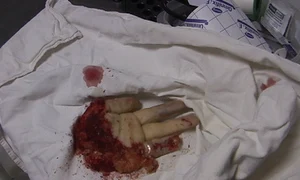 Mâna tăiata a femeii de 52 de ani jpeg