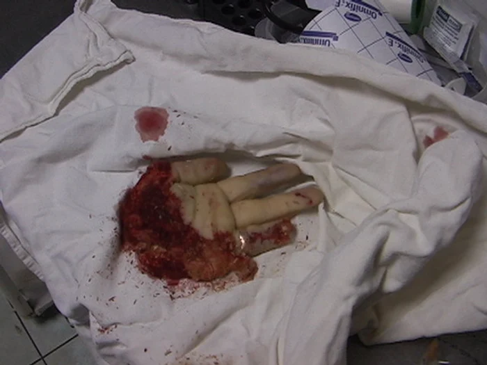 Mâna tăiata a femeii de 52 de ani