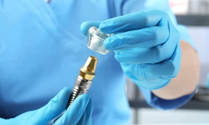 Ce include pretul unui implant dentar complet De la consultatie la control final jpg
