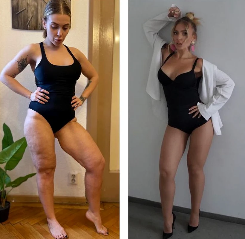 oana radu celulita jpg