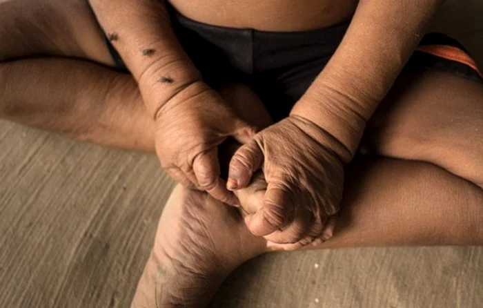 
    La doar patru ani, arată ca un bătrân de 80 de aniFoto Daily Mail  