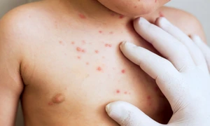 copil bolnav varicela boli infectioase simptome shutterstock 1166341723 jpg