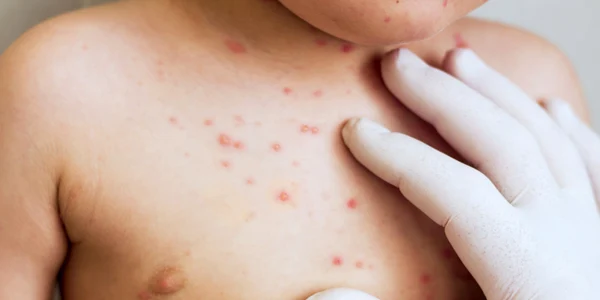 copil bolnav varicela boli infectioase simptome shutterstock 1166341723 jpg
