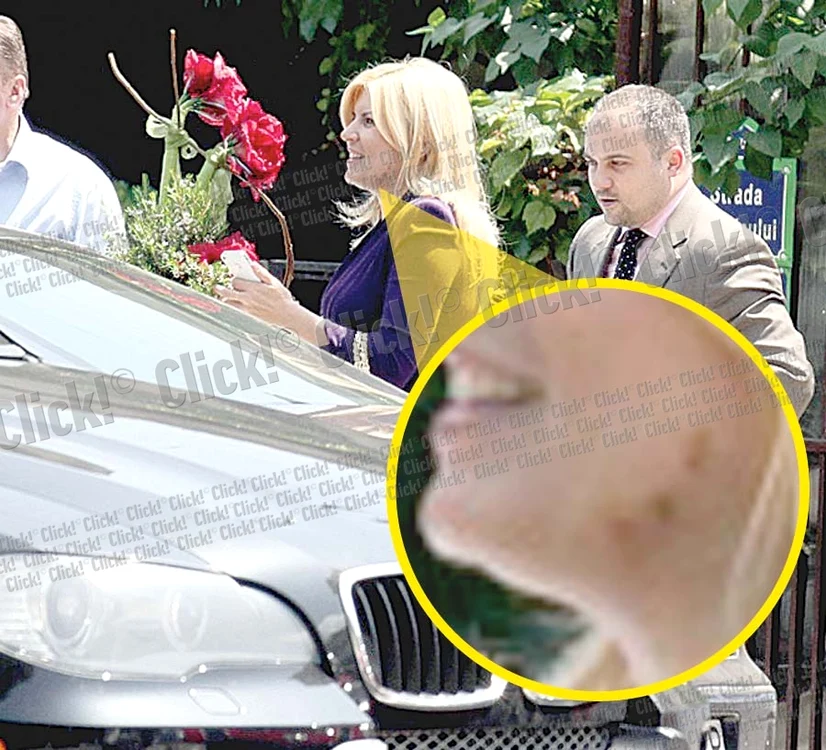 
    Mai 2012- Petele de pe faţă  sunt vizibile, chiar  dacă sunt acoperite  cu fond de ten  