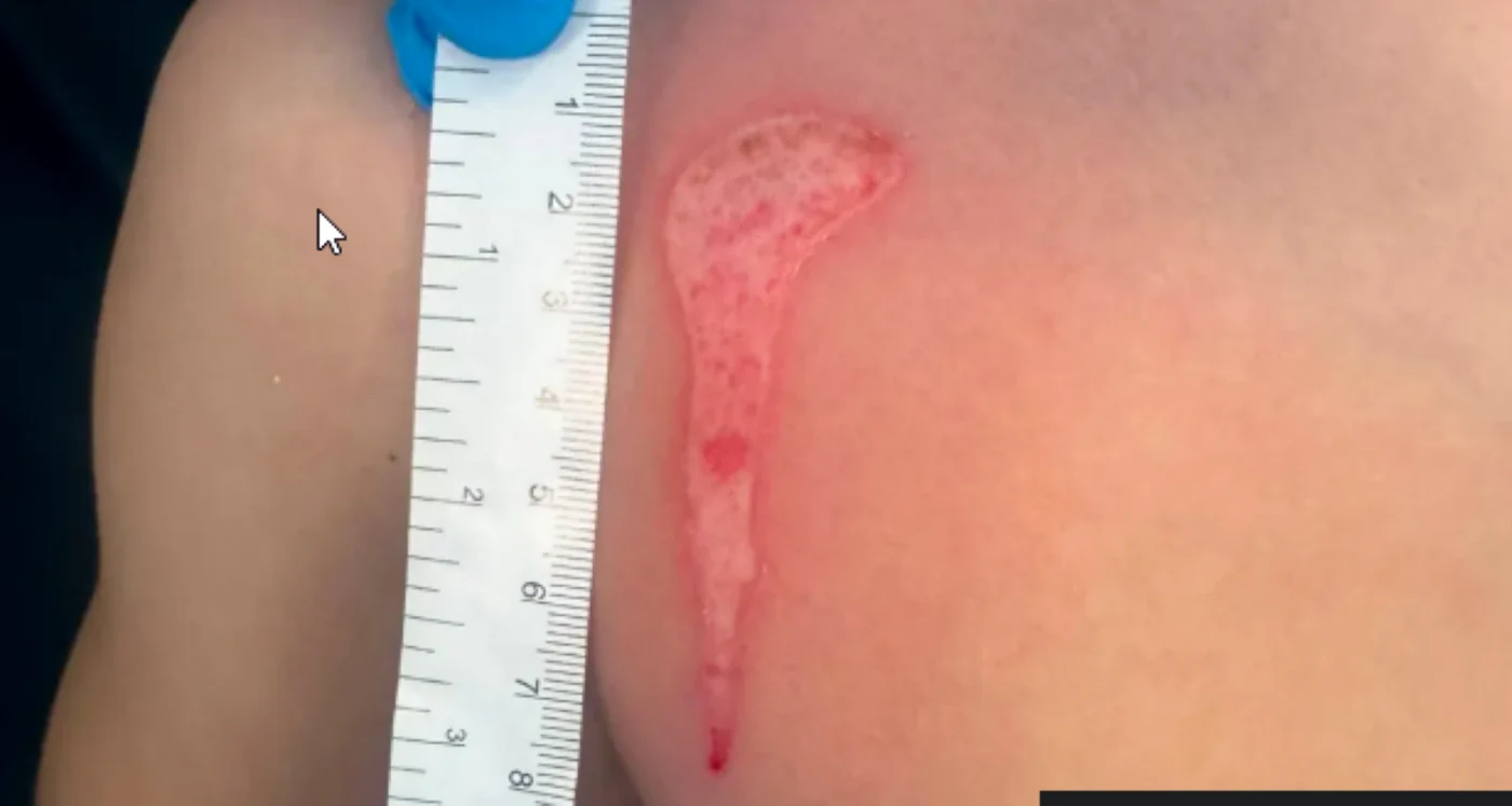 Gelul din squishy s-a luat cu piele cu tot. FOTO: NHS Greater Glasgow and Clyde