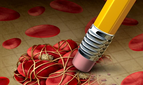 Atentie la cheagurile de sange  Sursa foto Shutterstock jpg