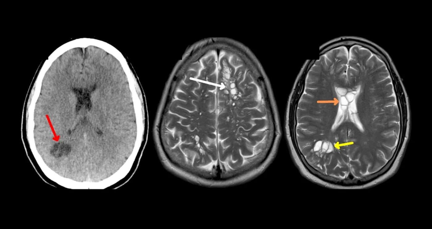 Scanările CT au evidențiat numeroase focare chistice FOTO American Journal of Case Reports/ NBC