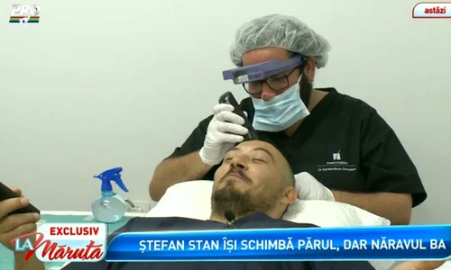 Stefan Stan şi a facut implant de par jpeg