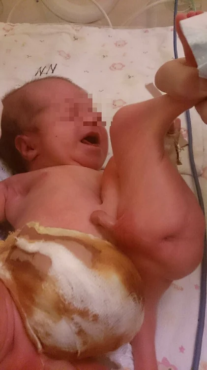 Fătul nedezvoltat este separat de băiețelul sănătos