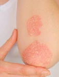 1 psoriazis jpg jpeg