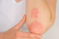 1 psoriazis jpg jpeg