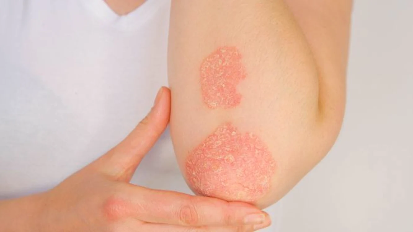 1 psoriazis jpg jpeg