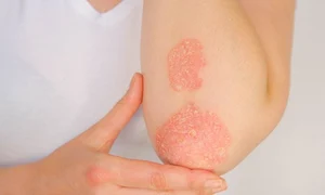 1 psoriazis jpg jpeg