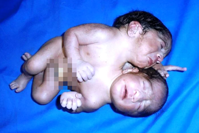 Medicii nu cred că bebeluşul cu două capete va supravieţuiFoto: CEN