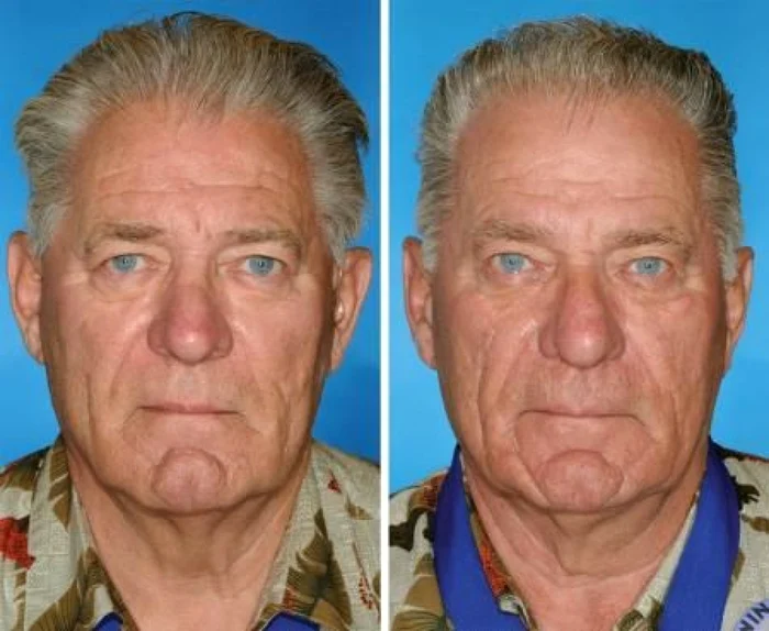 Fratele din dreapta a fumat cu numai cinci ani mai mult decât cel din stânga FOTO The American Society of Plastic Surgeons