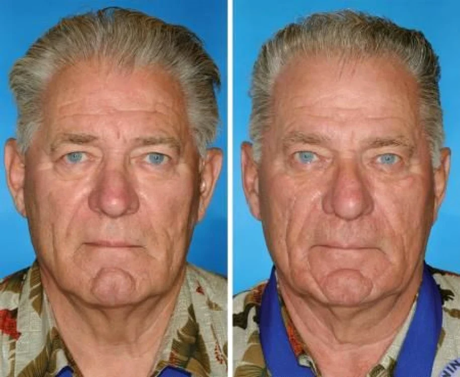 Fratele din dreapta a fumat cu numai cinci ani mai mult decât cel din stânga FOTO The American Society of Plastic Surgeons