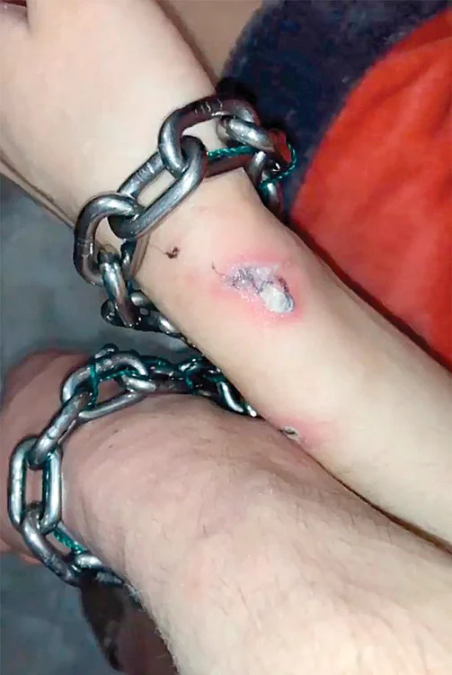Mâna captivă a fetei s-a infectat din cauza lanţuluiFoto: Instagram