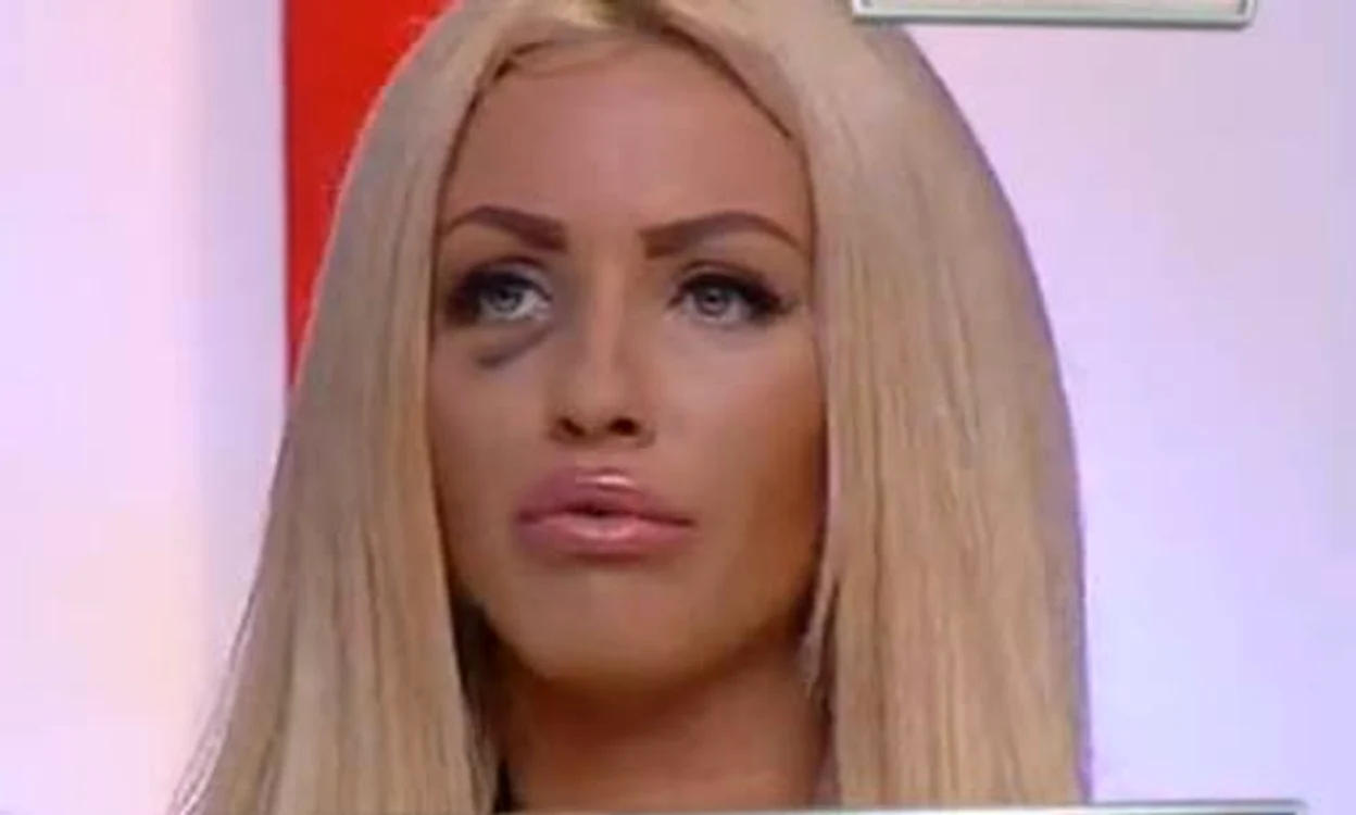
    Loredana Chivu s-a ales cu un ochi vânătFoto: Captură Kanal D  