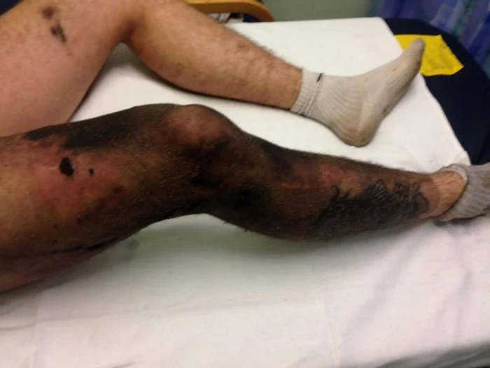 Bărbatul a suferit arsuri foarte grave după ce țigara electronică i-a explodat în buzunarFoto Metro.co.uk