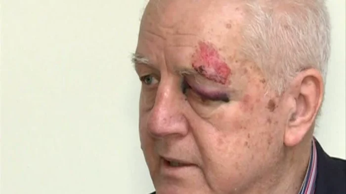 
    Jean Pădureanu a suferit o contuzie puternică la arcadă (Foto: RTV.net)  