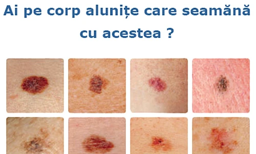 Simptome cancer de piele  Câte tipuri de cancer există, cum se manifestă şi ce tratament se aplică png