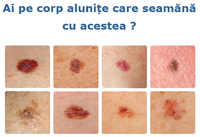 Simptome cancer de piele  Câte tipuri de cancer există, cum se manifestă şi ce tratament se aplică png