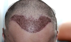 implant par drfelixhairimplant 5 jpg